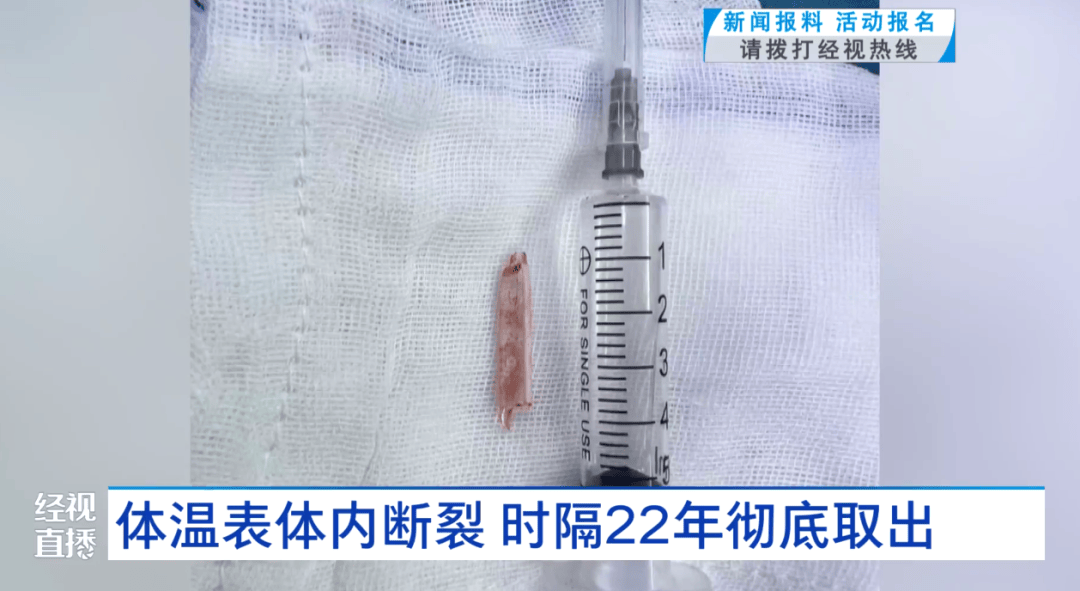 体温表在体内断裂<strong></p>
<p>黑马股票</strong>，女子时隔22年彻底取出！医生：庆幸水银不在里面